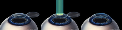 lasik eye surgery diagram